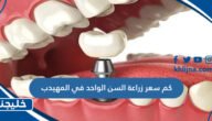 كم سعر زراعة السن الواحد في المهيدب