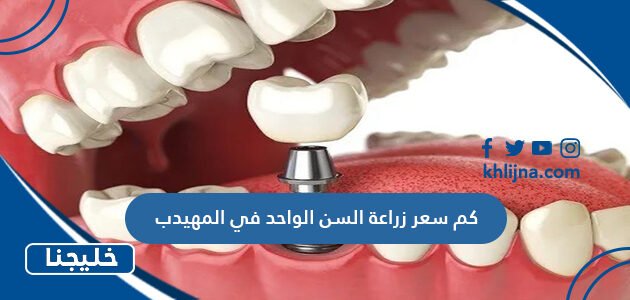 كم سعر زراعة السن الواحد في المهيدب