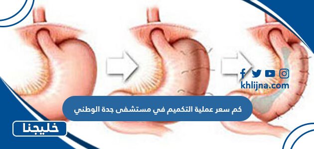 كم سعر عملية التكميم في مستشفى جدة الوطني