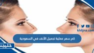كم سعر عملية تجميل الأنف في السعودية 2 كم سعر عملية تجميل الأنف في السعودية