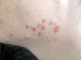 ما هو مرض الساركويد ويكيبيديا 1 ما هو مرض الساركويد ويكيبيديا