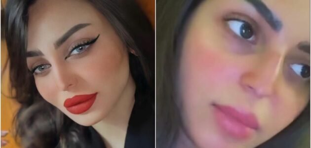 رهف القحطاني قبل وبعد عمليات التجميل