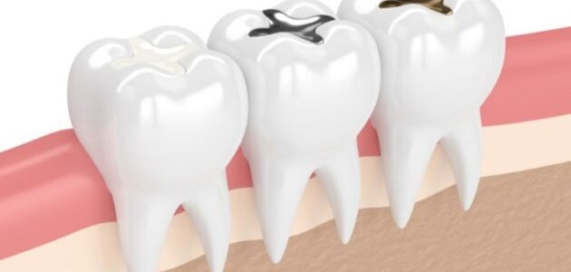 أنواع حشوات الاسنان في الكويت وافضلها 2023