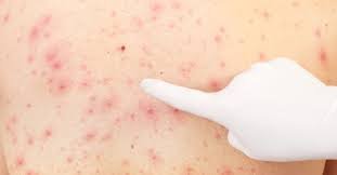 كم مدة مرض بوشوكة – خليجنا 1 كم مدة مرض بوشوكة – خليجنا