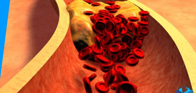 علاج التسريب الوريدي والاعراض والاسباب 1 علاج التسريب الوريدي والاعراض والاسباب