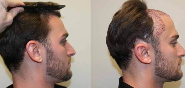 زراعة الشعر في تركيا 2022 معلومات تفصيلية