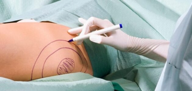 تجربتي مع الدكتور رياض البقمي في شفط الدهون