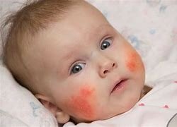 هل مرض الذئبة الحمراء مميت – خليجنا