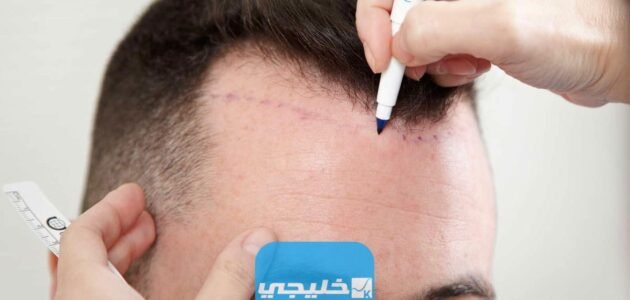أفضل عيادة لزراعة الشعر في الكويت 2023