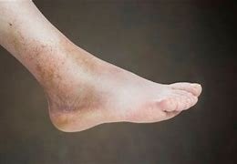 متى يكون تورم القدمين خطر للحامل – خليجنا