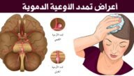ما هو تمدد الأوعية الدموية
