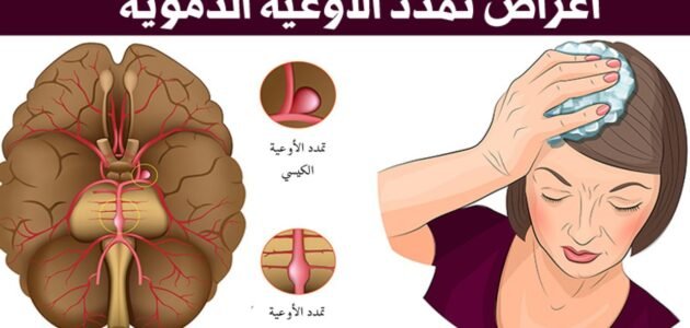 ما هو تمدد الأوعية الدموية