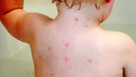 بالصور شكل الجدري في بدايته