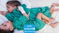 نجاح عملية فصل توأم سيامي سوري في السعودية.. تفاصيل الخبر