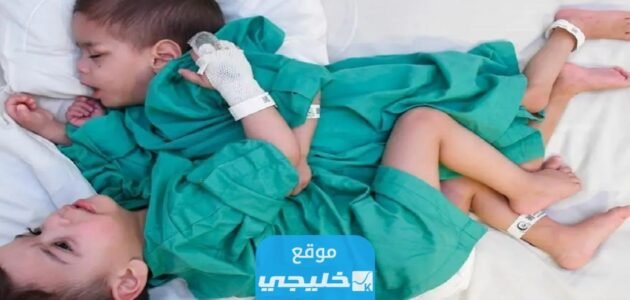 نجاح عملية فصل توأم سيامي سوري في السعودية.. تفاصيل الخبر