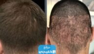 افضل مراكز زراعة الشعر في الكويت 2023 ⁩