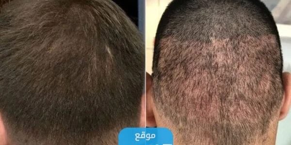 افضل مراكز زراعة الشعر في الكويت 2023 ⁩