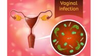 شكل الالتهابات المهبلية بالصور – خليجنا