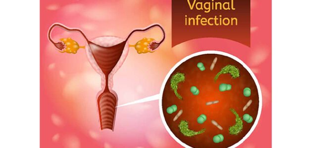 شكل الالتهابات المهبلية بالصور – خليجنا