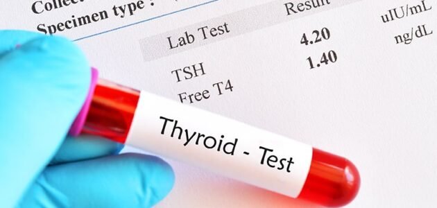 كيف تقرأ تحليل الغدة الدرقية