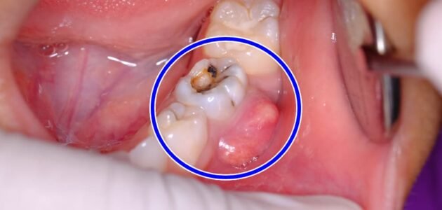 ما هو خراج الاسنان وعلاجه