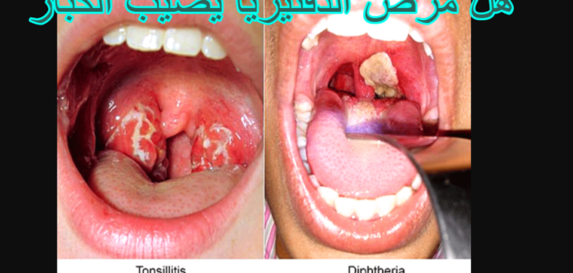 ما هو مرض دفتيريا ويكيبيديا وعلاجه