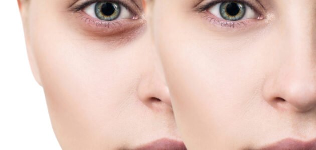 وداعا للهالات السودا تحت العين 1 وداعا للهالات السودا تحت العين