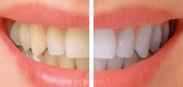 وصفات طبيعية فعالة لتبيض الأسنان والتخلص من الجير والاصفرار بشكل نهائي