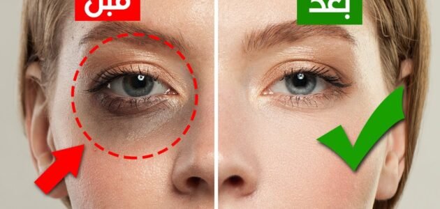 وصفات طبيعية للتخلص من البثور والهالات السوداء والرؤوس والمسامات الواسعة