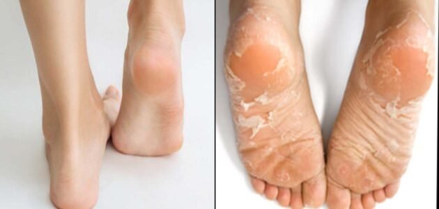 طريقة مذهلة لـ تقشير القدمين في المنزل بوصفات سهلة وبسيطة