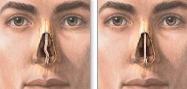 ما هو انحراف الوتيرة ويكيبيديا