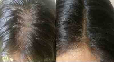 مكون طبيعي فعّال لتحسين كثافة ونمو الشعر وملئ الفراغات 1 مكون طبيعي فعّال لتحسين كثافة ونمو الشعر وملئ الفراغات