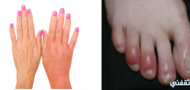 أسباب تورم اليدين والقدمين في الشتاء وما هي طرق العلاج