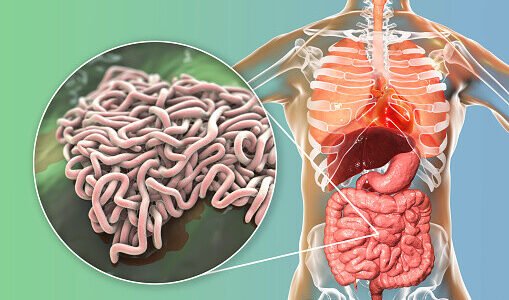 كيف تتخلص من ديدان البطن نهائياً للأطفال والكبار؟ 1 كيف تتخلص من ديدان البطن نهائياً للأطفال والكبار؟