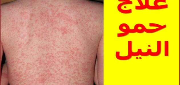 كيف أعالج الحمونيل في المنزل للكبار والصغار ؟ 1 كيف أعالج الحمونيل في المنزل للكبار والصغار ؟