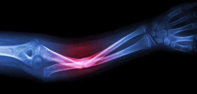 لماذا تلتئم العظام المكسورة ؟ 1 لماذا تلتئم العظام المكسورة ؟