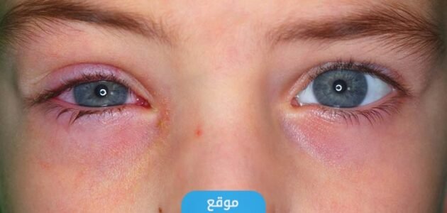 ما هو وباء العين الوردية تفاصيل كاملة