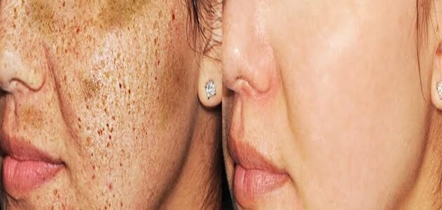 وشك هينور زي البدر.. وصفة سحرية لازالة الكلف والبقع السوداء والبثور