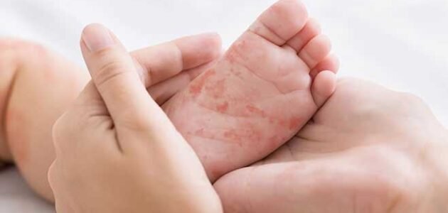 افضل دكتور جلدية أطفال في الرياض