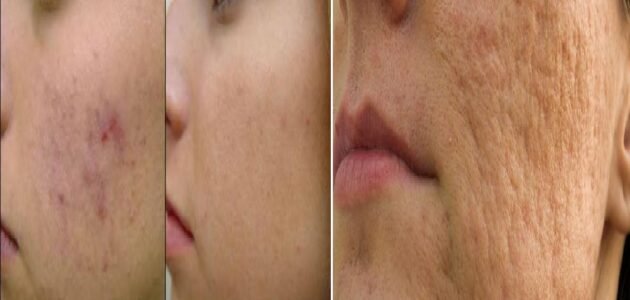 وصفة طبيعية لعلاج حب الشباب وآثاره بشكل سريع وفعال 1 وصفة طبيعية لعلاج حب الشباب وآثاره بشكل سريع وفعال