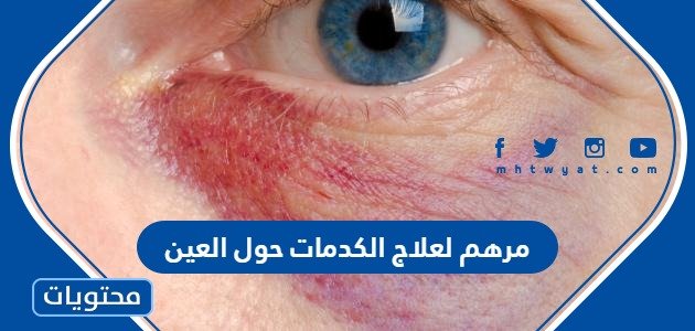 افضل مرهم لعلاج الكدمات حول العين