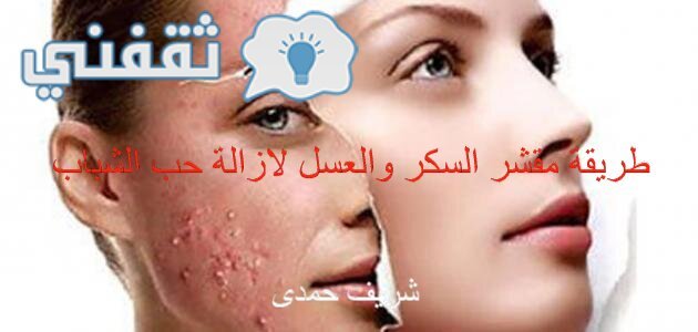 طريقة مقشر السكر والعسل لإزالة حب الشباب