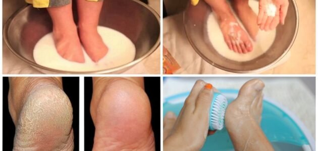 لقدمين كالحرير.. التخلص من تشققات الكعبين بطرق طبيعية وفعّالة 1 لقدمين كالحرير.. التخلص من تشققات الكعبين بطرق طبيعية وفعّالة