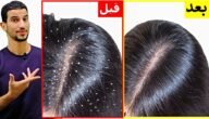 وصفة منزلية خارقة للقضاء على قشرة الشعر نهائيا وزيادة طول شعرك