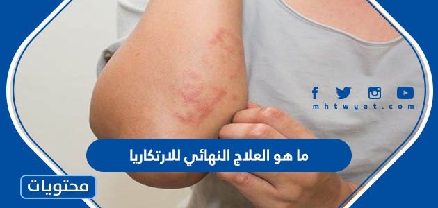 ما هو العلاج النهائي للارتكاريا