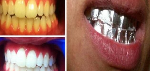 ماذا يحدث عند تغطية أسنانك بورق الألمنيوم لمدة ساعة النتيجة ستبهرك
