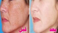 أقوى وصفة طبيعية لعلاج الكلف والبقع الداكنة.. مجربة والنتيجة ممتازة