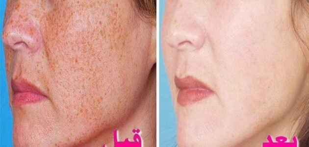 أقوى وصفة طبيعية لعلاج الكلف والبقع الداكنة.. مجربة والنتيجة ممتازة