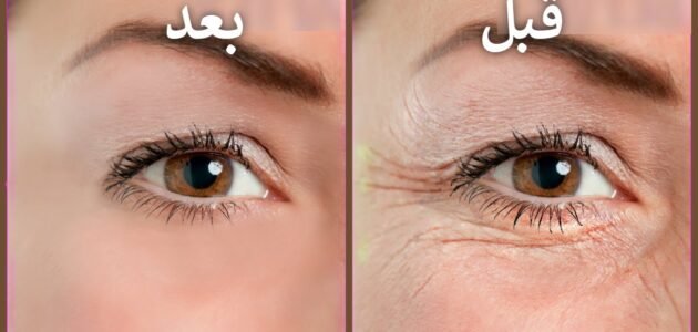  فيلر طبيعي للتخلص من الخطوط الرفيعة حول العين والفم بمكونات اقتصادية