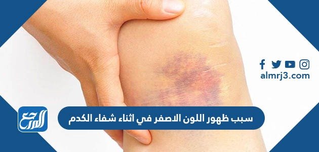ما سبب ظهور اللون الاصفر في اثناء شفاء الكدم – خليجنا